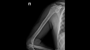 Укладка плечевой кости