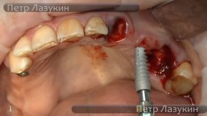 Закрытый синус-лифтинг