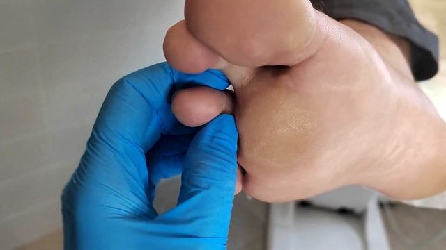 Огромная мозоль смотреть онлайн