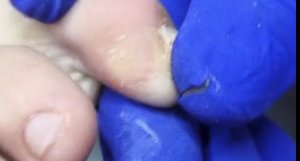 Мозоль между пальцами + разгрузка ???⚠️