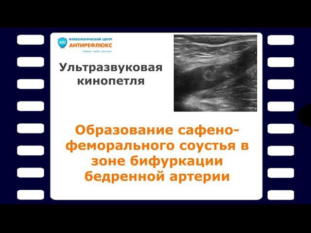 Образование сафено-феморального соустья в зоне бифуркации бедренной артерии смотреть онлайн
