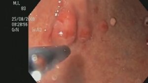 Полипы желудка. Быстрое удаление у бабушки 83-х лет.