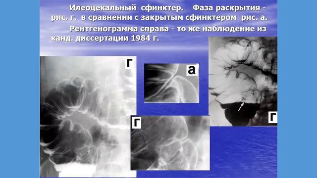 ИЛЕОЦЕКАЛЬНЫЙ СФИНКТЕР смотреть онлайн