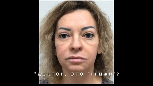 Чек лифтинг и верхняя блефаропластика. До и после. Пластический хирург Архангельск, Тула.Козлов В.Н смотреть онлайн