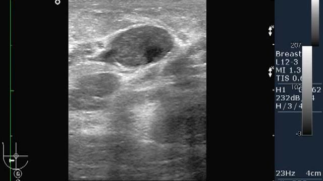 УЗИ молочной железы. смотреть онлайн