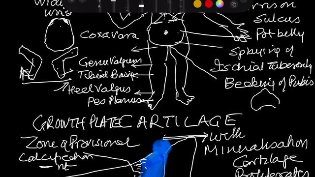 Metabolic Bone Diseases Irregularities of Osteoid and Mineral GK Singh ERALMCH смотреть онлайн