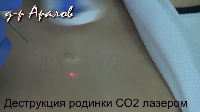 Удаление родинки лазером. Removal of dermal nevus by laser. смотреть онлайн
