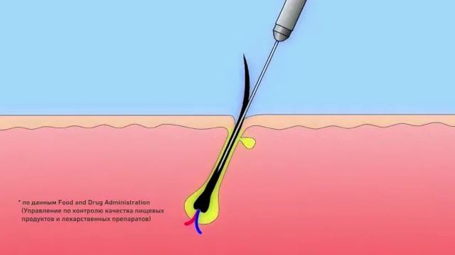 Электроэпиляция избавляет от волос НАВСЕГДА! смотреть онлайн