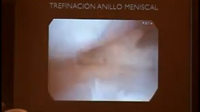 TRASPLANTE DE MENISCO/ DR DAVID CHUNG ARCEO/ dvd14 7 смотреть онлайн