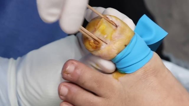 EXTREME INFECTED INGROWN TOENAIL REMOVAL ***WARNING GRAPHIC***