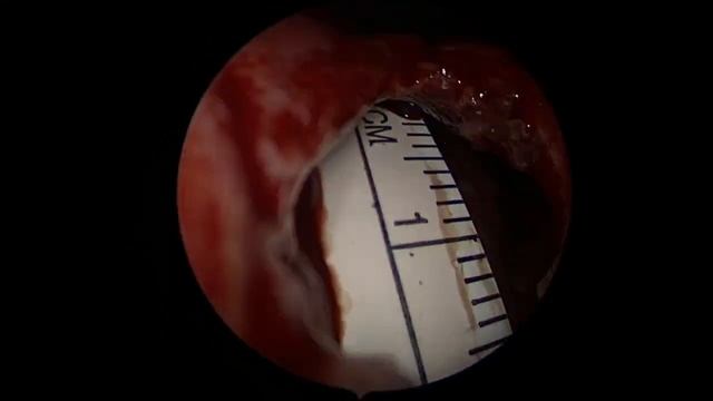 Закрытие перфорации перегородки носа. Nasal perforation repair surgery. смотреть онлайн