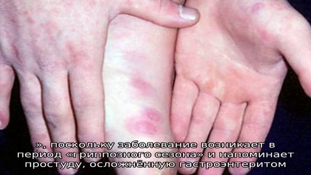 Лечим реовирусную инфекцию смотреть онлайн