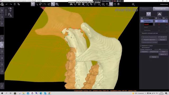 Фрагментация челюстных костей смотреть онлайн