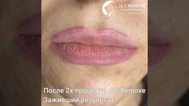 До после губы. Удаление татуажа ремувером Jet Remove.