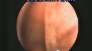 Центральный рак лёгкого. Бронхоскопия с биопсией.