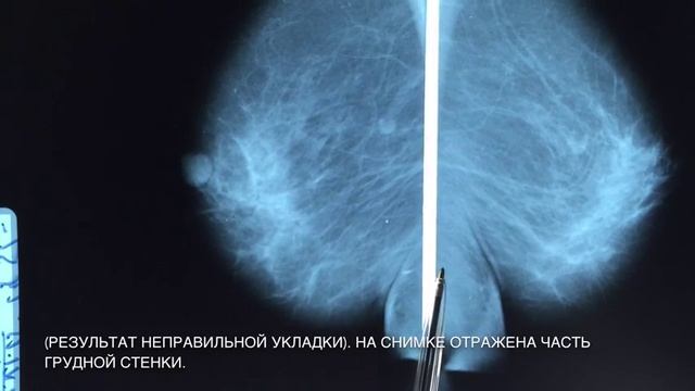 ПРОБЛЕМЫ СОВРЕМЕННОЙ МАММОГРАФИИ! смотреть онлайн
