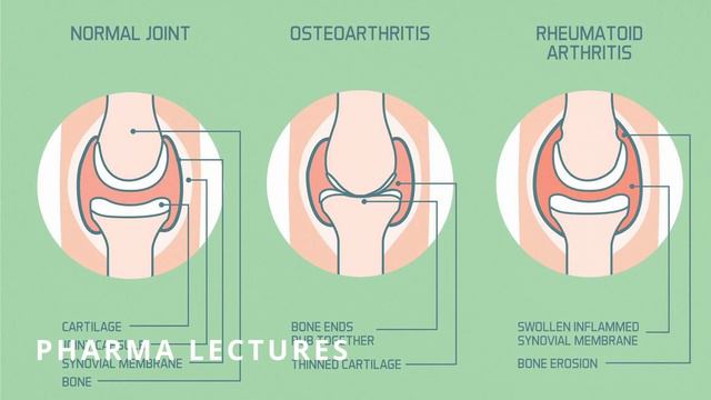 Sulfasalazine 500 mg Tablet ll Saaz Tablet ll Sulfasalazine Tablet ll смотреть онлайн