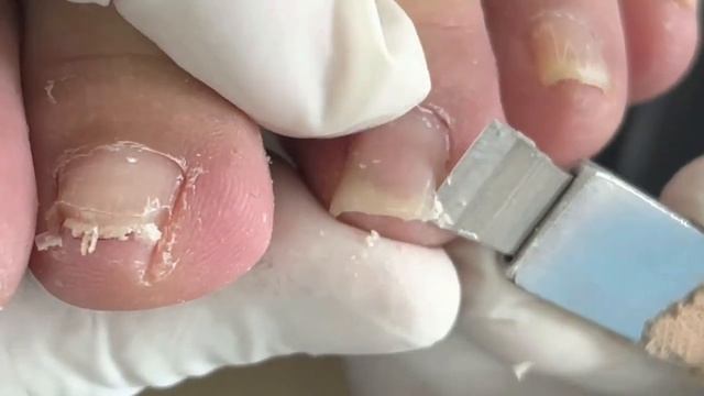 Inflamed Toenails，pull Out Ingrown Toenails【Foot Scalpel】