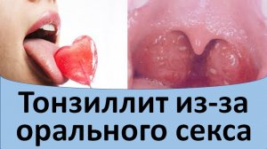 Тонзиллит после орального секса