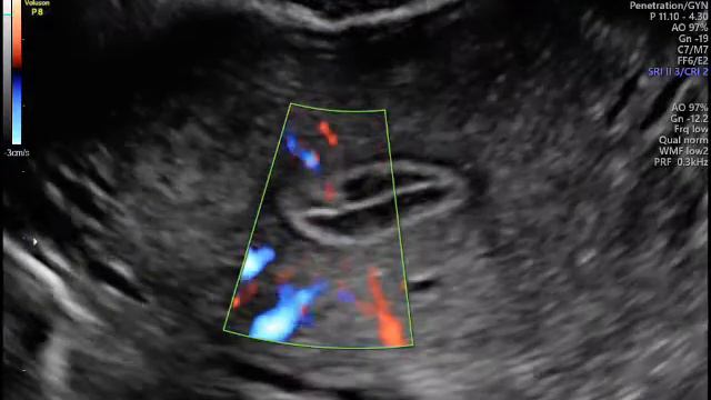 Полип эндометрия. Режим направленного допплера. смотреть онлайн