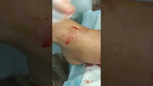 Erysipelas/Рожистое воспаление.Флегмона голени.