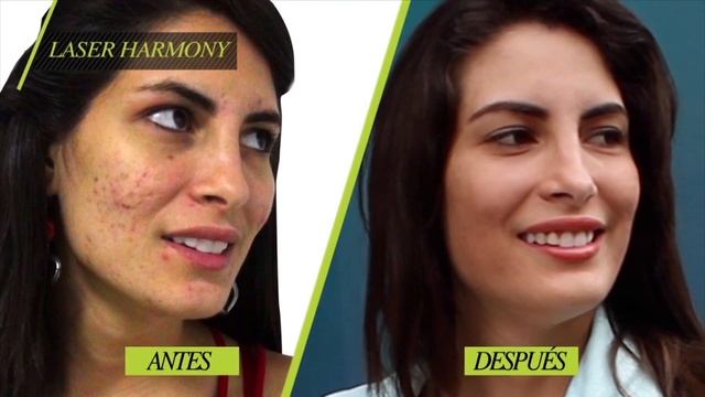 Stefanie te cuenta cómo está su piel después del LASER HARMONY смотреть онлайн