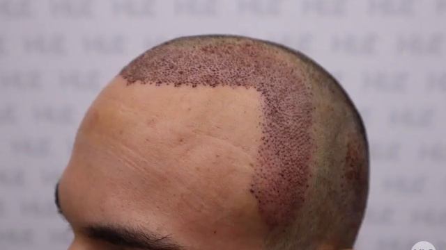 Лечение залысин пересадкой волос - Результат трансплантации 3630 графтов - Клиника HLC в Турции смотреть онлайн