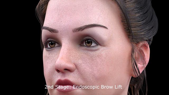 Brow, Forehead, Almond Eyes, Mid Face Lift (Endoscopic Pentalift) Güncel Öztürk, M.D. - DRGO смотреть онлайн