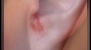 Стрептодермия у взрослых и детей