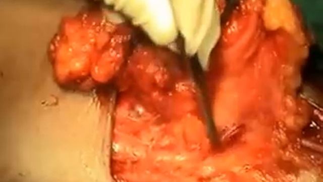 Modified Inguinal Block Dissection смотреть онлайн