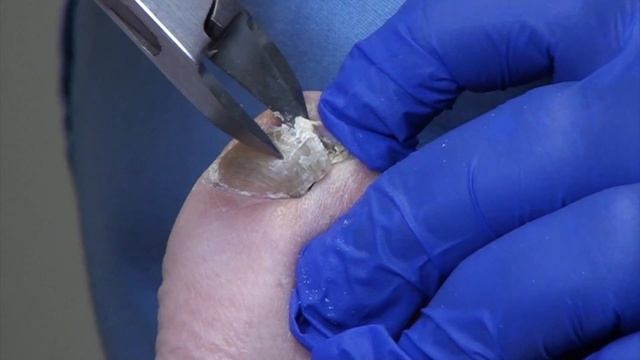 Two Big Thick Toenails.  Is This Fungal Nails? [Dr Nail Nipper] (2020)