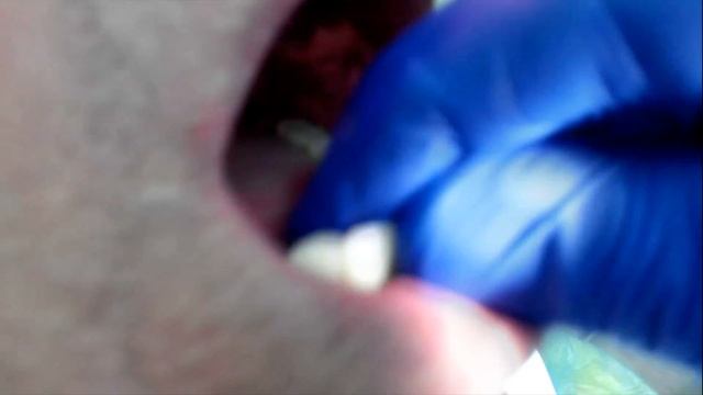 4-я стоматология. Новые полные съемные протезы слепками ＂старых＂.4-я стоматология. Новые полные съем