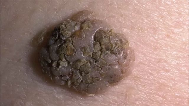 Кератомы - фото кератом, причины их появления. Как избавиться от кератом. смотреть онлайн