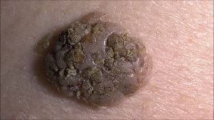 Кератомы - фото кератом, причины их появления. Как избавиться от кератом.