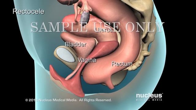 Pelvic Prolapse | Nucleus Health