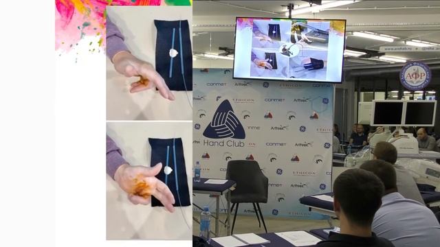 Как терапевт кисти лечит контрактуры. Ольга Земляков. смотреть онлайн