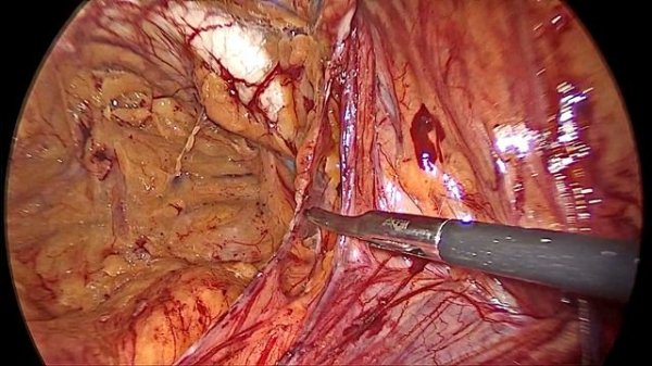 Лапароскопическая TAPP герниопластика