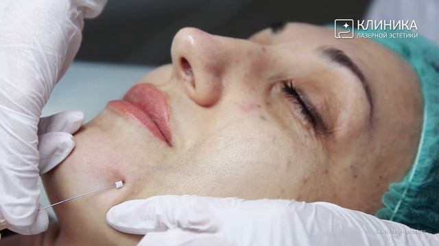 Тредлифтинг мезонити смотреть онлайн