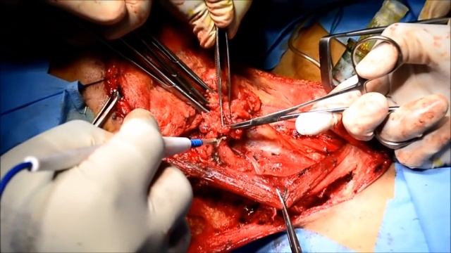 NECK DISSECTION step by step смотреть онлайн