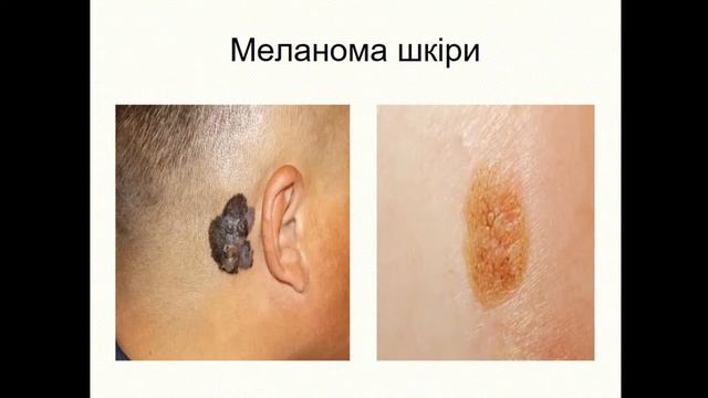 Лекція на тему: Пухлини меланінутворюючої та нервової тканин смотреть онлайн