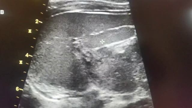 Узи селезенки, добавочная селезенка * смотреть онлайн