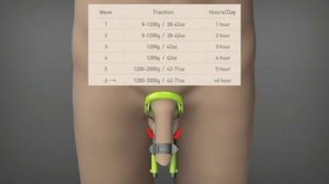 Экстендеры MaleEdge официальное видео