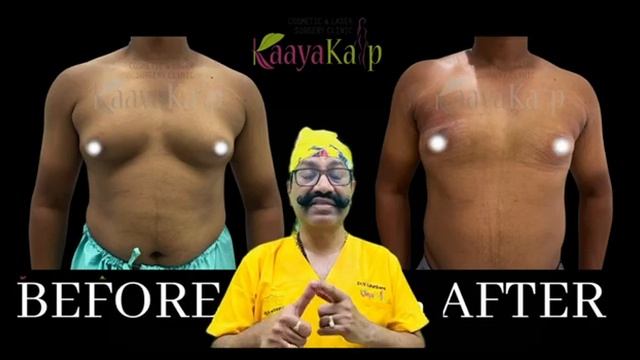 What is Gynecomastia Treatment? Explained by Dr. V. S. Rathore | #Gynecomastia #surgery смотреть онлайн