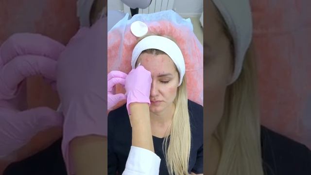 Ботулинотерапия, чтобы поднять брови смотреть онлайн