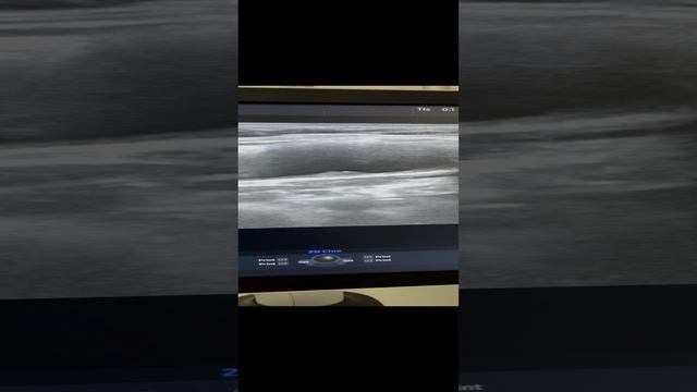 Атеросклероз сонных артерий. Лечение атеросклероза. Узи сосудов. Сосудистый хирург. Флеболог Москва смотреть онлайн