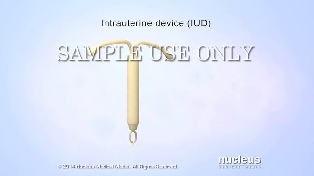 Patient Education Video: Intrauterine Device (IUD)