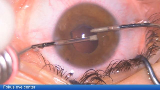 Lentis Comfort Uveitic eye Lukan Mishev Live Stream смотреть онлайн
