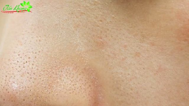 Hướng Dẫn Cách Trị Mụn Cám Bằng Mật Ong An Toàn Và Hiệu Quả Nhất смотреть онлайн