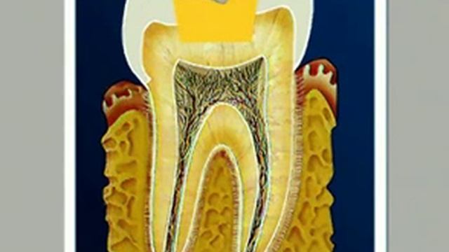 Как развивается кариес. смотреть онлайн
