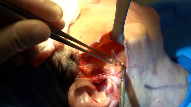 Facelift Surgery: Local Anesthesia, Laser & Fat Grafting | Princeton MD смотреть онлайн
